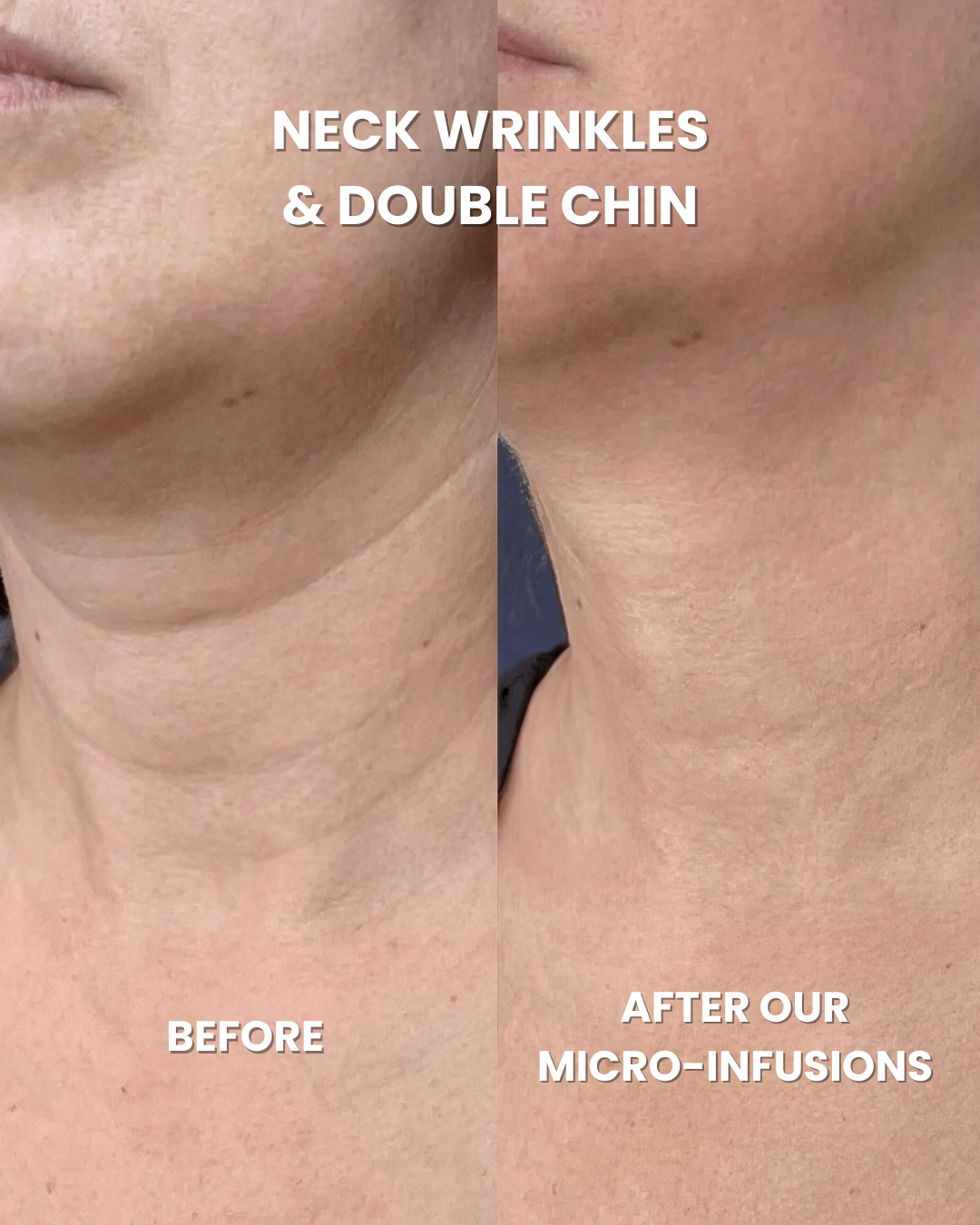 Anti-Aging Micro Infusion