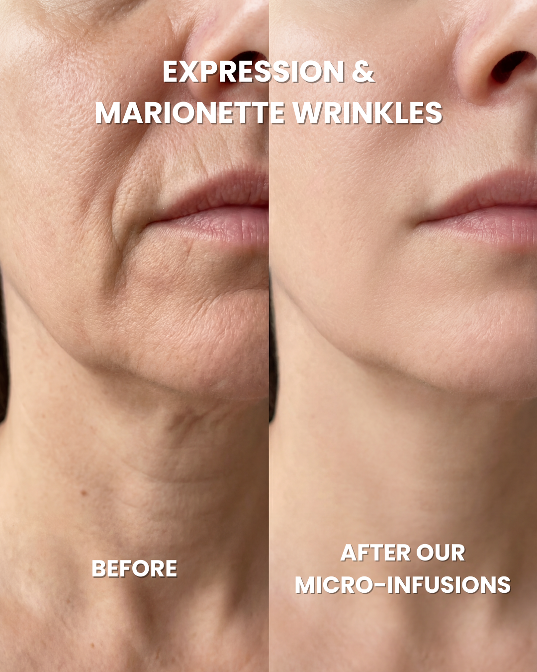 Anti-Aging Micro Infusion