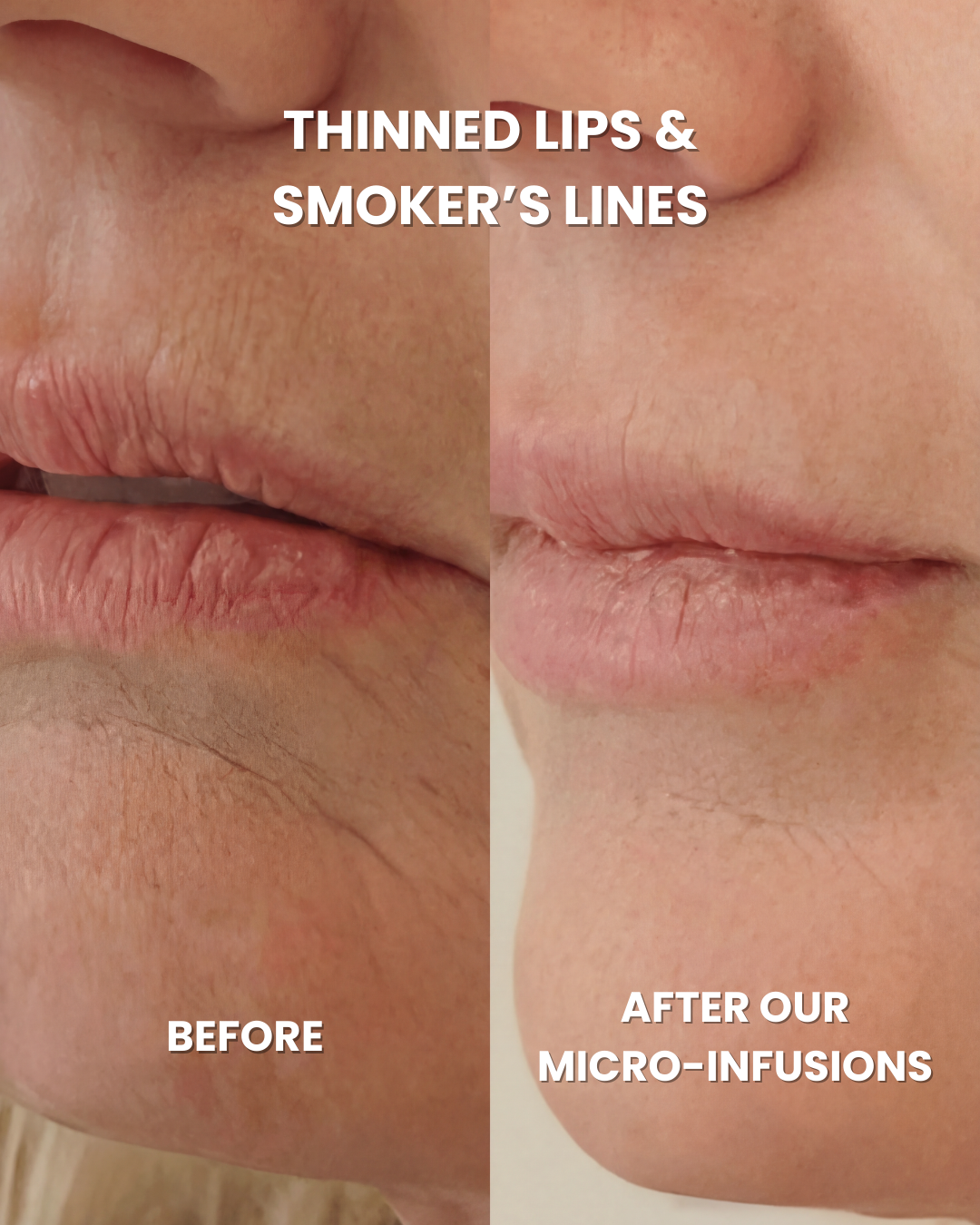 Anti-Aging Micro Infusion